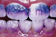 Mira 2 Ton Hager Werken plakdetectie sponsjes 250 st