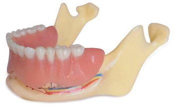 Studiemodel onderkaak met 4 implantaten in cylindrische vorm