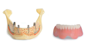 Studiemodel onderkaak met 4 implantaten in cylindrische vorm