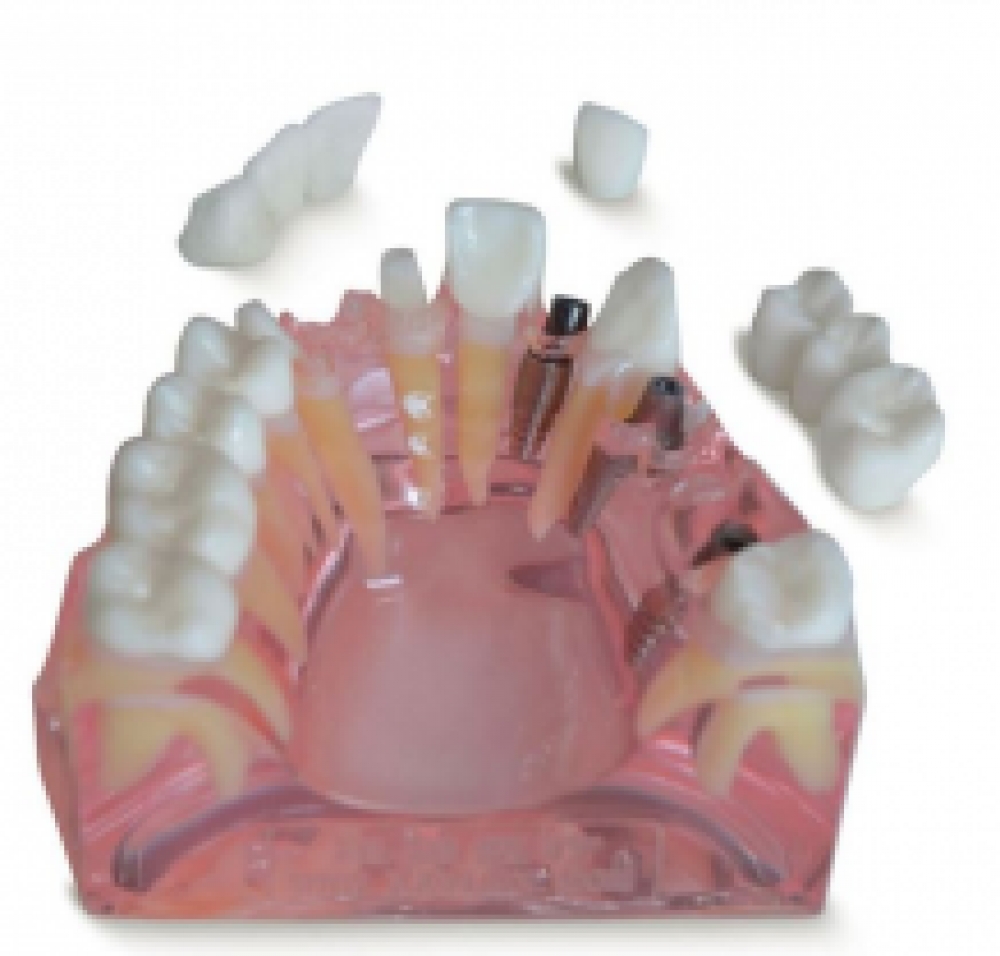 Modèle implantaire ceramic bridge + couronne