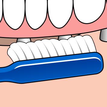 TePe® Implantaat/Orthodontie borstel 1x1 st